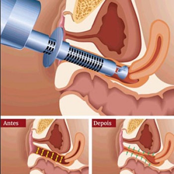 Laser de Co2 Vaginal